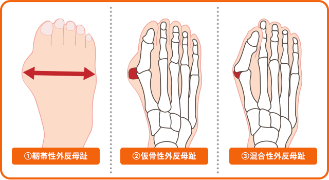 外反母趾の3パターン