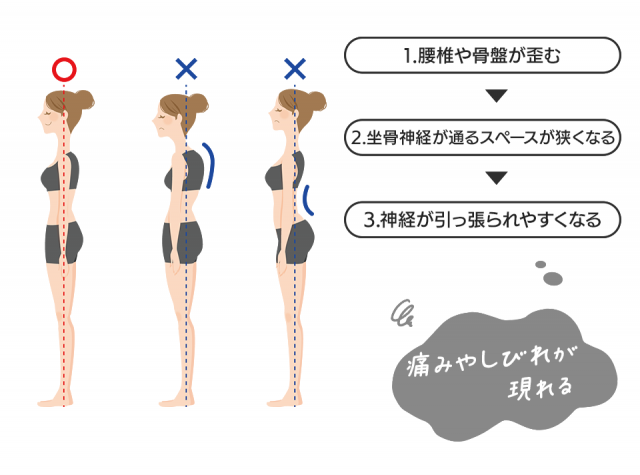 坐骨神経痛の症状が出るまでの流れ